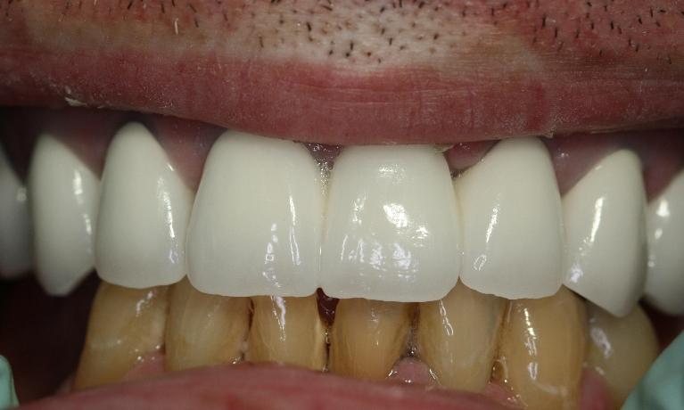 Cosmetic-Dentistry-After-Image