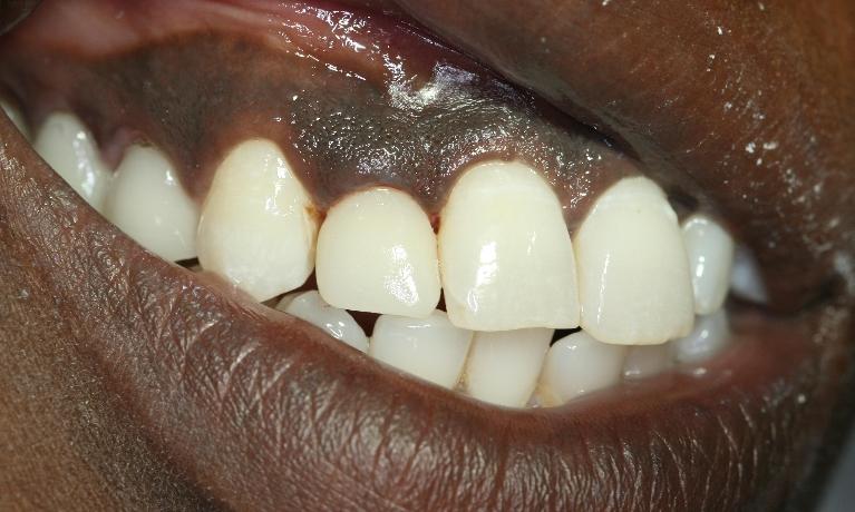 Crown-Replacement-After-Image