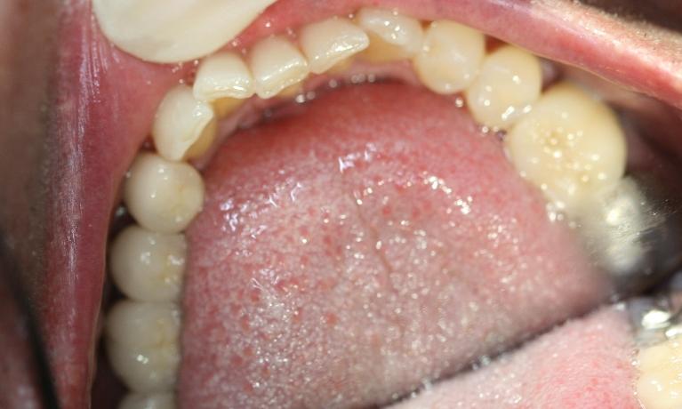 Dental-Implants-After-Image