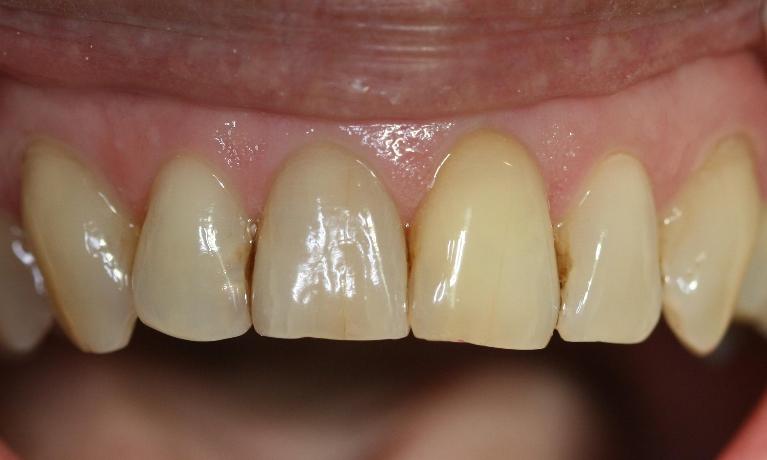 Internal-Bleaching-Case-After-Image