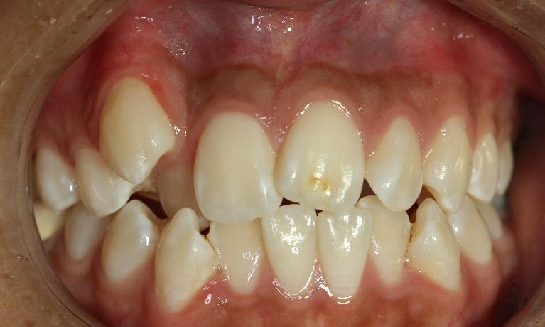 Orthodontics-Before-Image