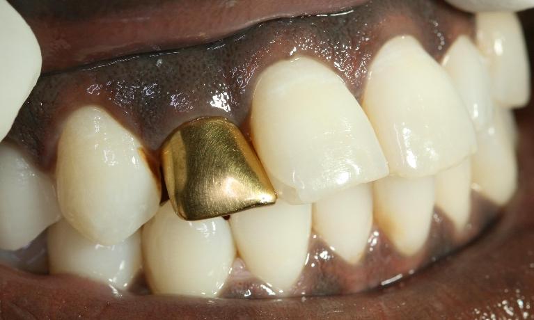Crown-Replacement-Before-Image