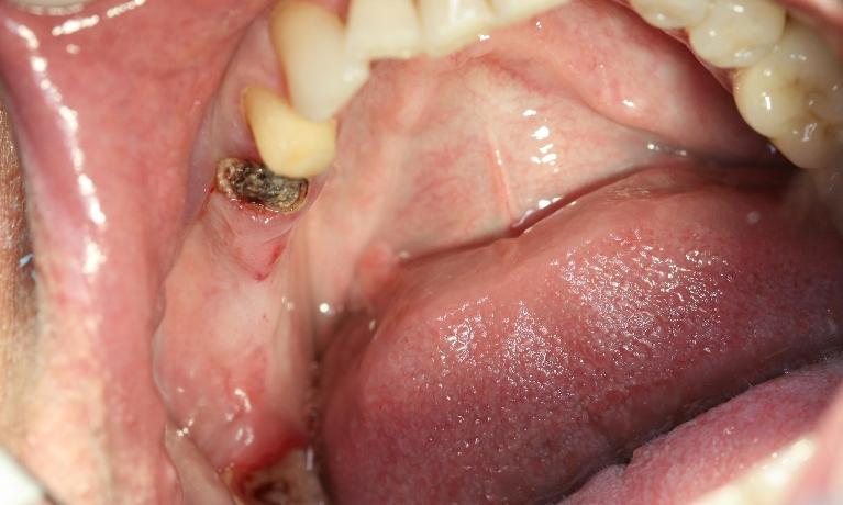 Dental-Implants-Before-Image
