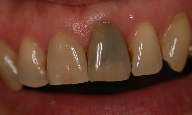 Internal-Bleaching-Case-Before-Image